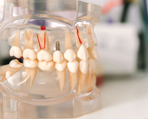 Implantologia dentale cuneo